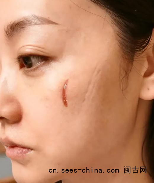 杨蓉晒烫伤后疤痕恢复照